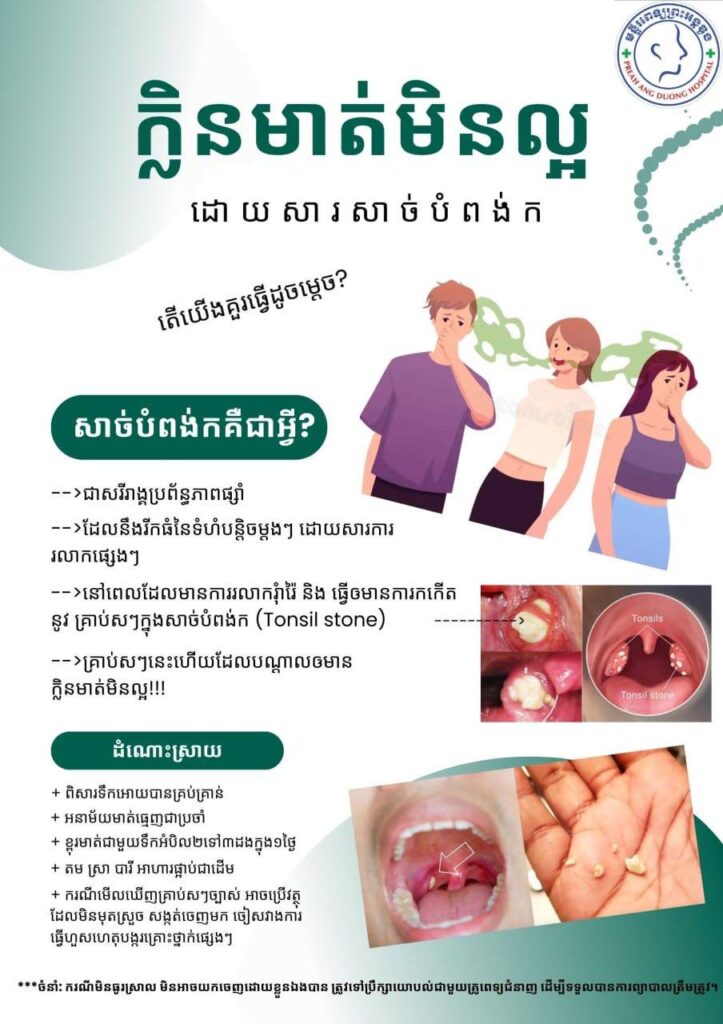 ក្លិនមាត់មិនល្អ ដោយសារសាច់បំពង់ក សាច់បំពង់កគឺជាអ្វី?